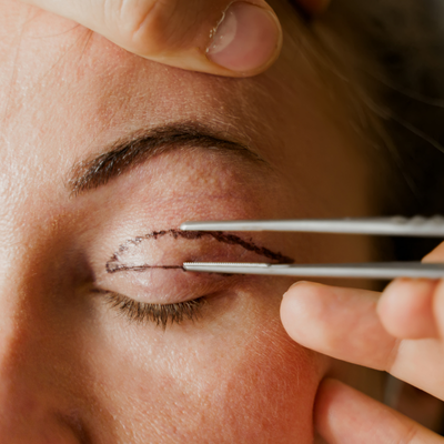 Blefaroplastia en Reñaca y Viña del Mar: por qué elegir un oculoplástico marca la diferencia