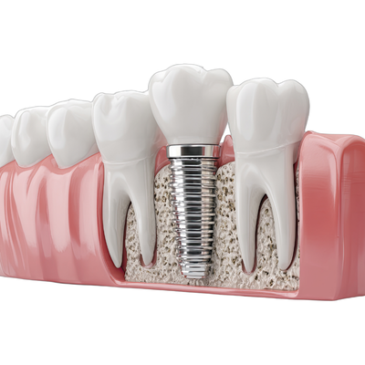 Implantes, diseño de sonrisa digital y tecnología CAD/CAM en Reñaca: odontología moderna para resultados más precisos